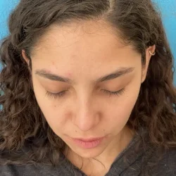Resultados rinoplastia N Quito13