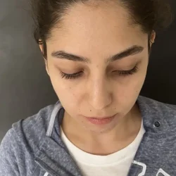 Resultados rinoplastia N Quito14
