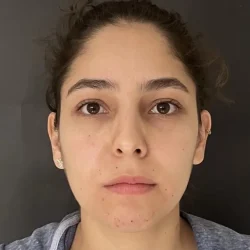 Resultados rinoplastia N Quito2