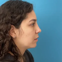 Resultados rinoplastia N Quito3
