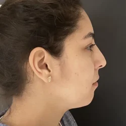 Resultados rinoplastia N Quito4