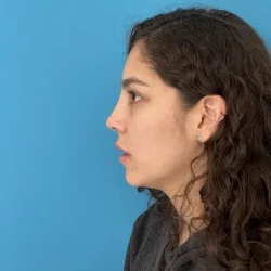 Resultados rinoplastia N Quito7