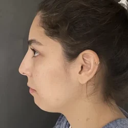 Resultados rinoplastia N Quito8