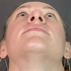 Resultados rinoplastia O Quito12