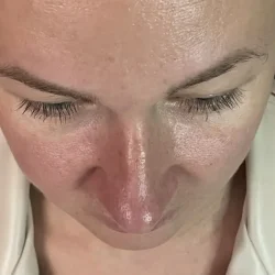 Resultados rinoplastia O Quito14