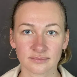 Resultados rinoplastia O Quito2