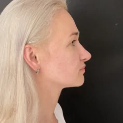 Resultados rinoplastia O Quito3