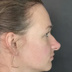 Resultados rinoplastia O Quito4