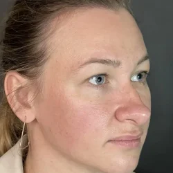 Resultados rinoplastia O Quito6