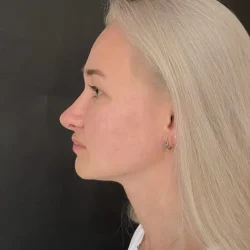 Resultados rinoplastia O Quito7