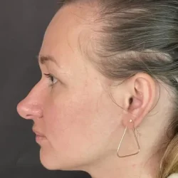Resultados rinoplastia O Quito8