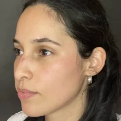 Resultados rinoplastia P Quito10