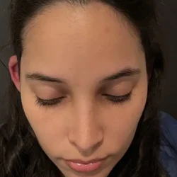 Resultados rinoplastia P Quito13