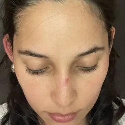 Resultados rinoplastia P Quito14