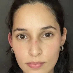 Resultados rinoplastia P Quito2