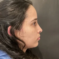 Resultados rinoplastia P Quito3