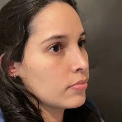 Resultados rinoplastia P Quito5