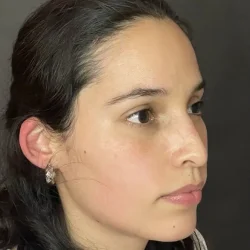 Resultados rinoplastia P Quito6