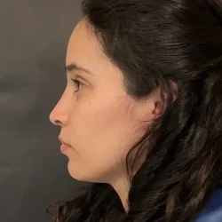 Resultados rinoplastia P Quito7