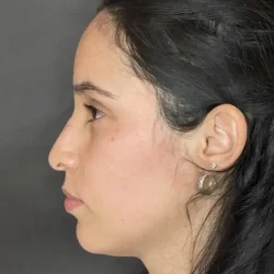 Resultados rinoplastia P Quito8