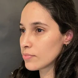Resultados rinoplastia P Quito9
