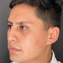 Resultados rinoplastia Q Quito10