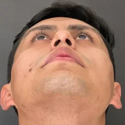 Resultados rinoplastia Q Quito12