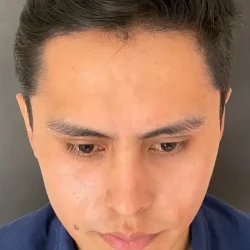 Resultados rinoplastia Q Quito13