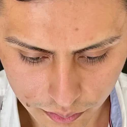 Resultados rinoplastia Q Quito14