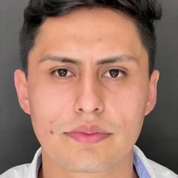 Resultados rinoplastia Q Quito2