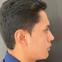 Resultados rinoplastia Q Quito3