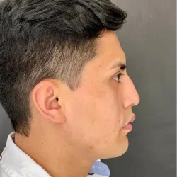 Resultados rinoplastia Q Quito4