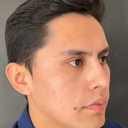 Resultados rinoplastia Q Quito5