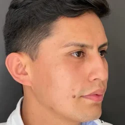 Resultados rinoplastia Q Quito6