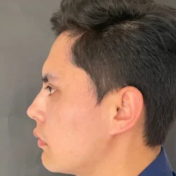 Resultados rinoplastia Q Quito7