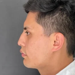 Resultados rinoplastia Q Quito8