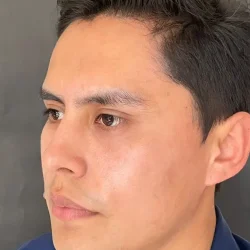 Resultados rinoplastia Q Quito9