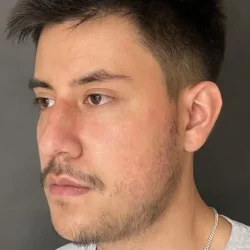 Resultados rinoplastia R Quito10
