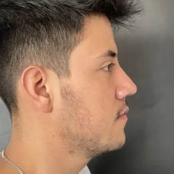 Resultados rinoplastia R Quito3