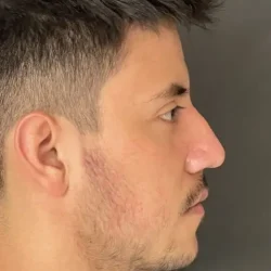 Resultados rinoplastia R Quito4