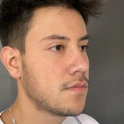 Resultados rinoplastia R Quito5