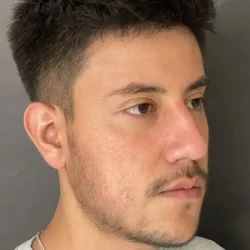 Resultados rinoplastia R Quito6