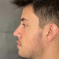 Resultados rinoplastia R Quito7