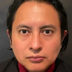 Resultados rinoplastia S Quito1
