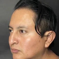 Resultados rinoplastia S Quito10