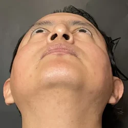 Resultados rinoplastia S Quito12