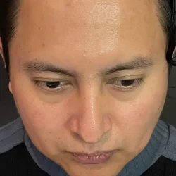 Resultados rinoplastia S Quito14