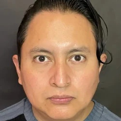 Resultados rinoplastia S Quito2