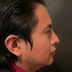 Resultados rinoplastia S Quito3