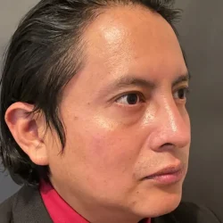Resultados rinoplastia S Quito5